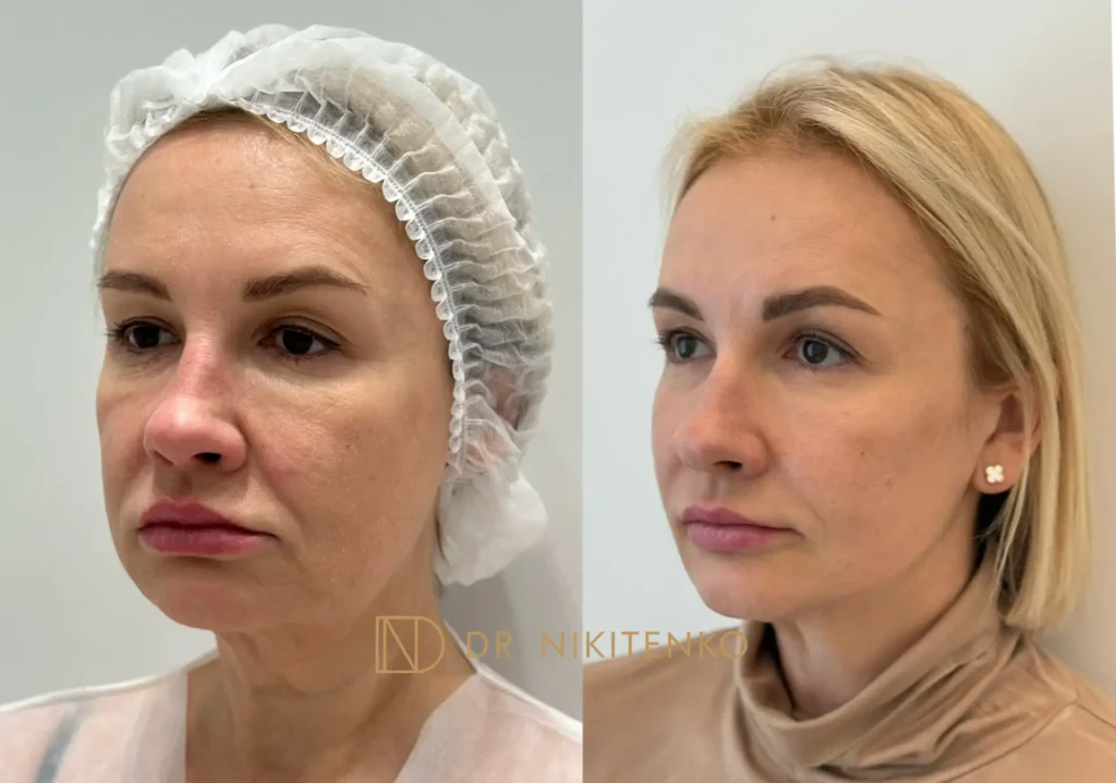 Нехирургический лазерный лифтинг ENDOLIFT