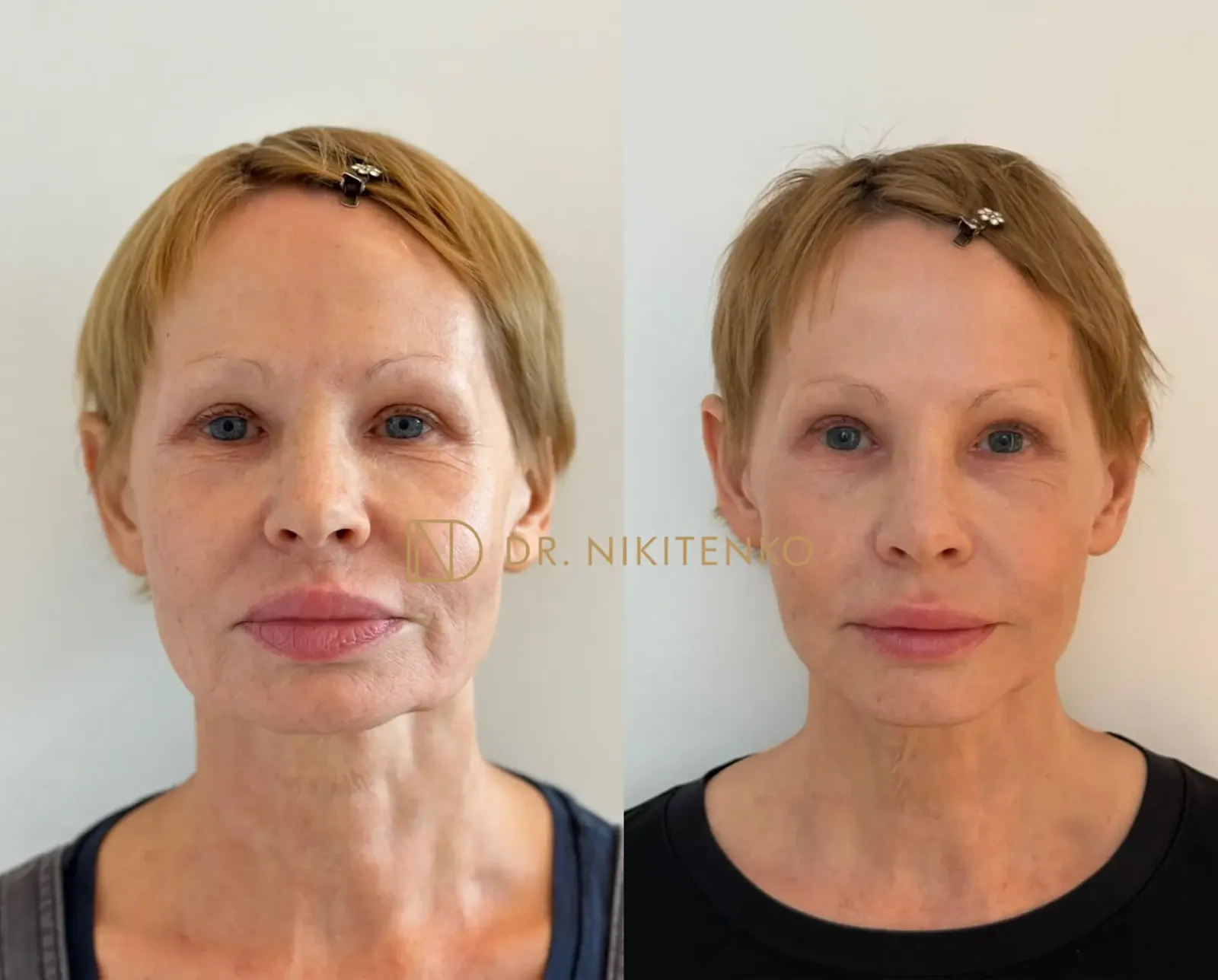 Нехирургический лазерный лифтинг ENDOLIFT: фото до и после