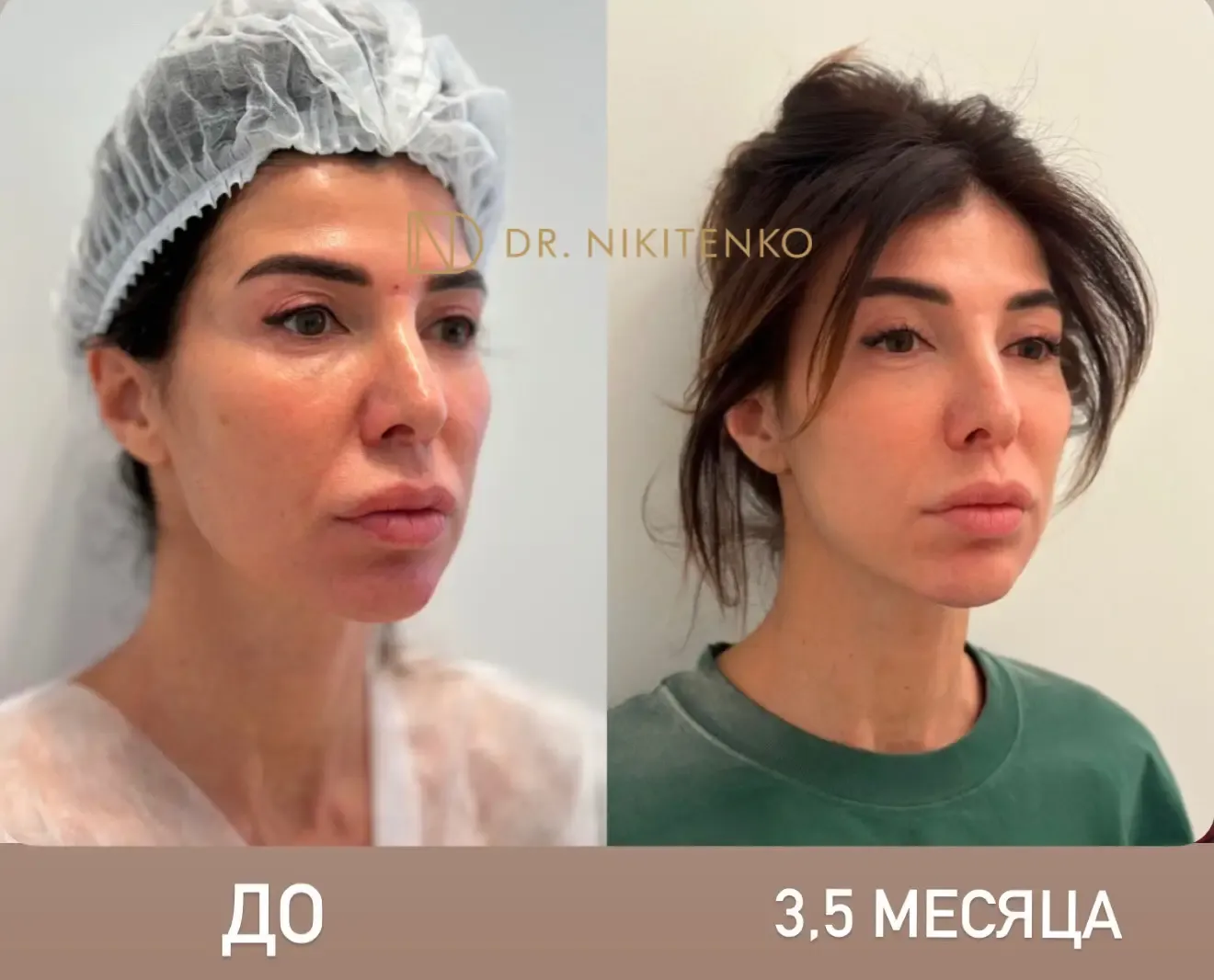 Нехирургический лазерный лифтинг ENDOLIFT: фото до и после