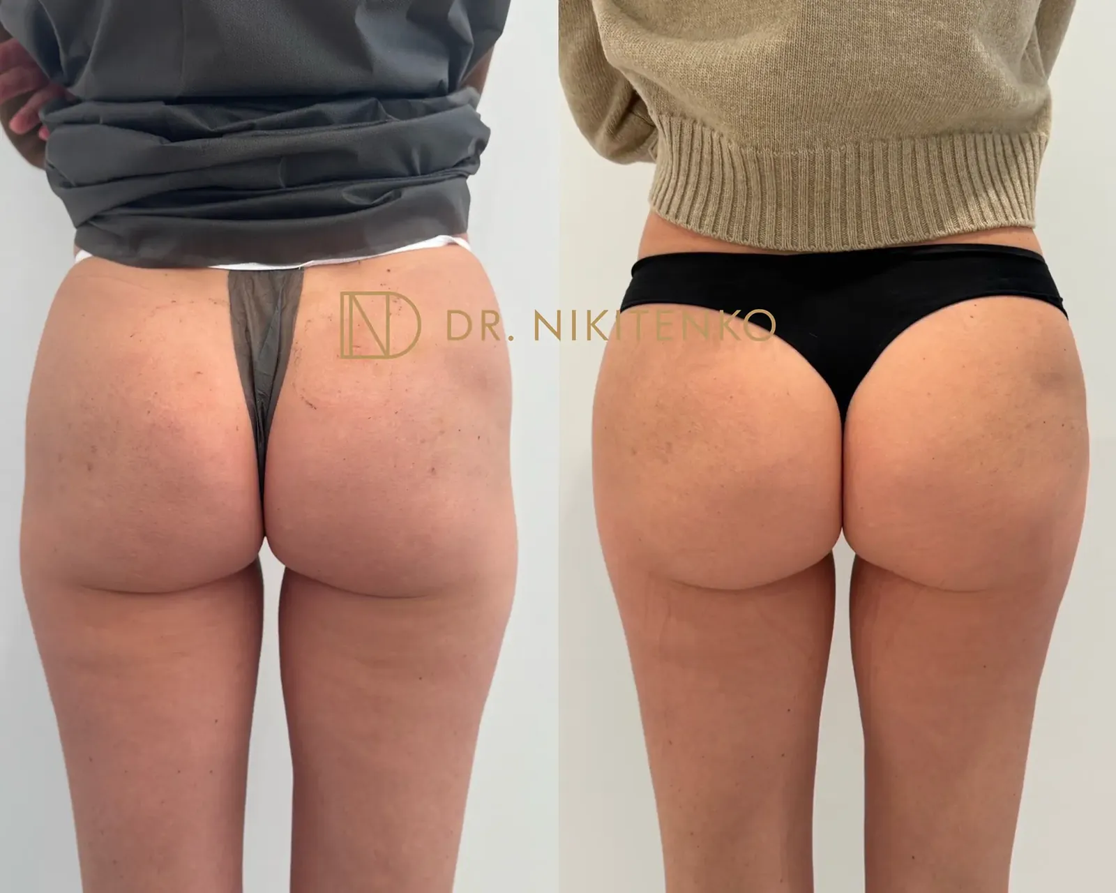 Нехирургический лазерный лифтинг ENDOLIFT: фото до и после
