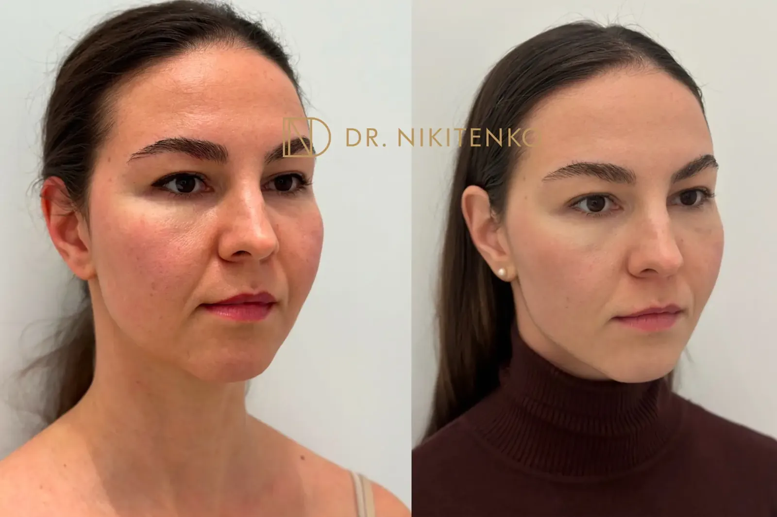Нехирургический лазерный лифтинг ENDOLIFT: фото до и после