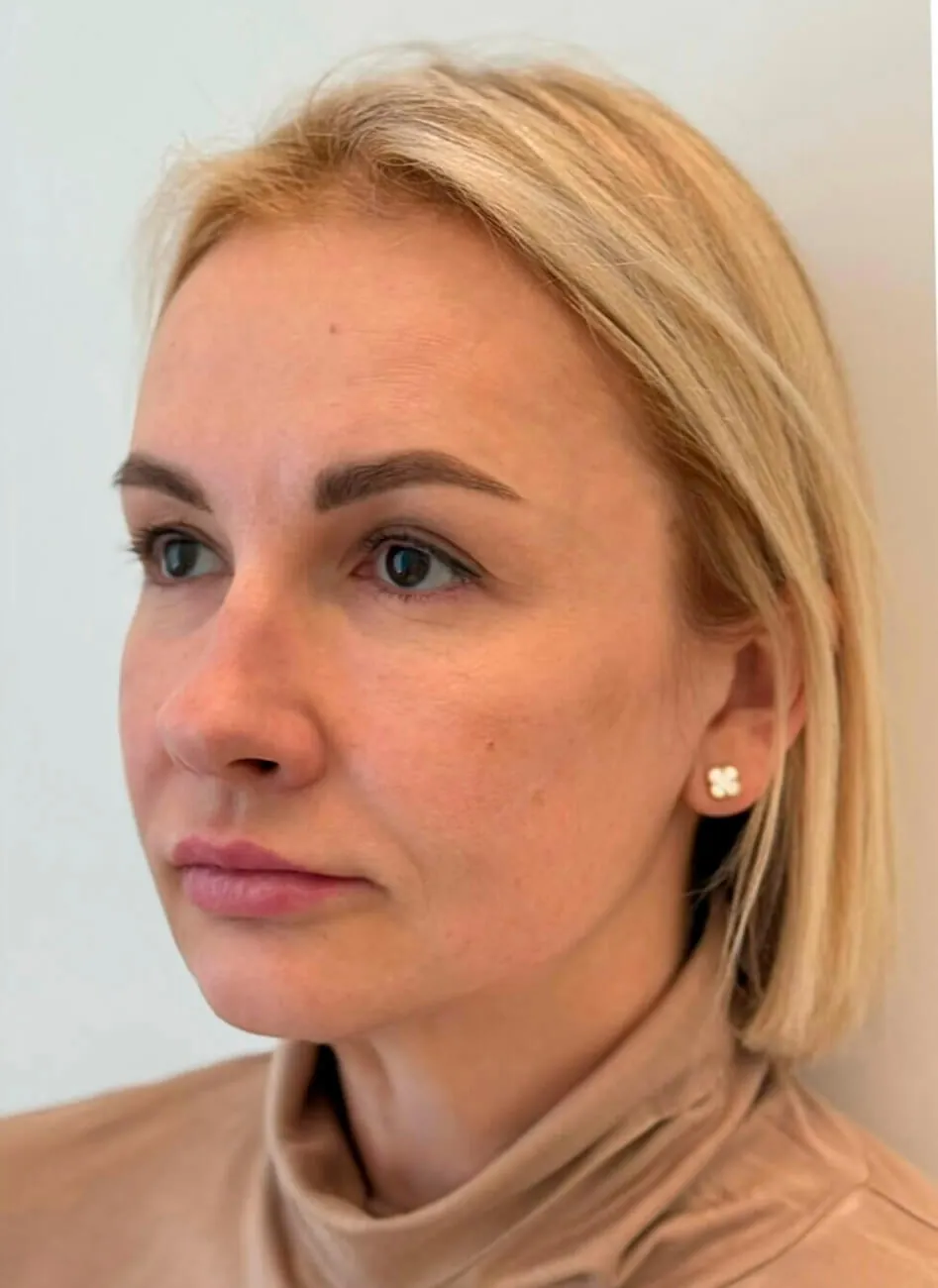 Эндолифтинг до и после