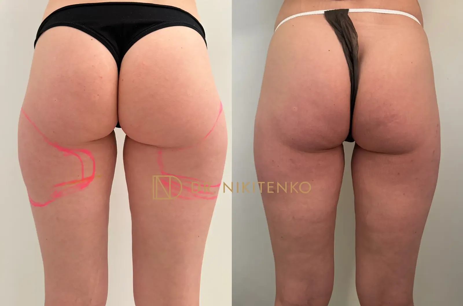 Нехирургический лазерный лифтинг ENDOLIFT: фото до и после