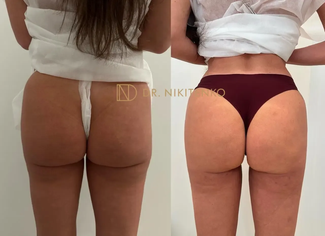 Нехирургический лазерный лифтинг ENDOLIFT: фото до и после