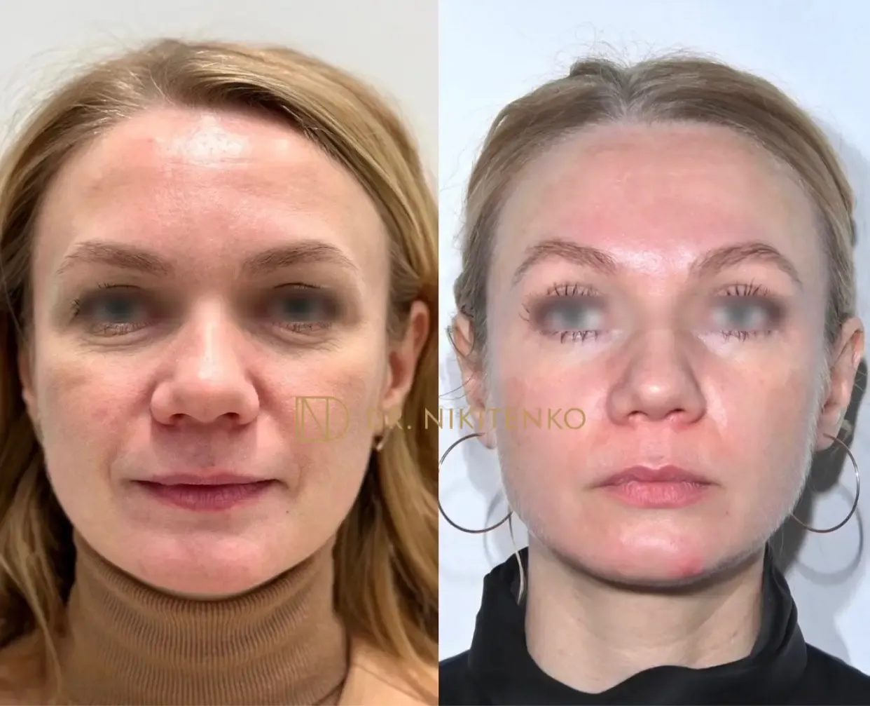Нехирургический лазерный лифтинг ENDOLIFT: фото до и после