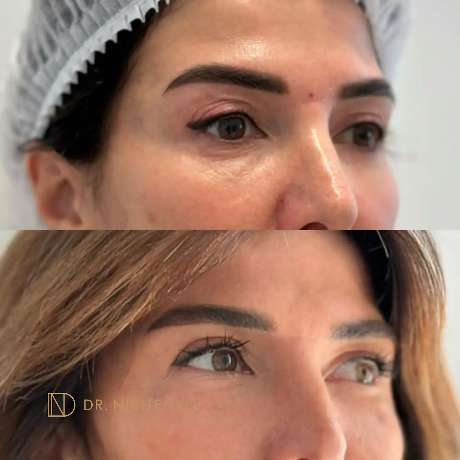 Нехирургический лазерный лифтинг ENDOLIFT: фото до и после