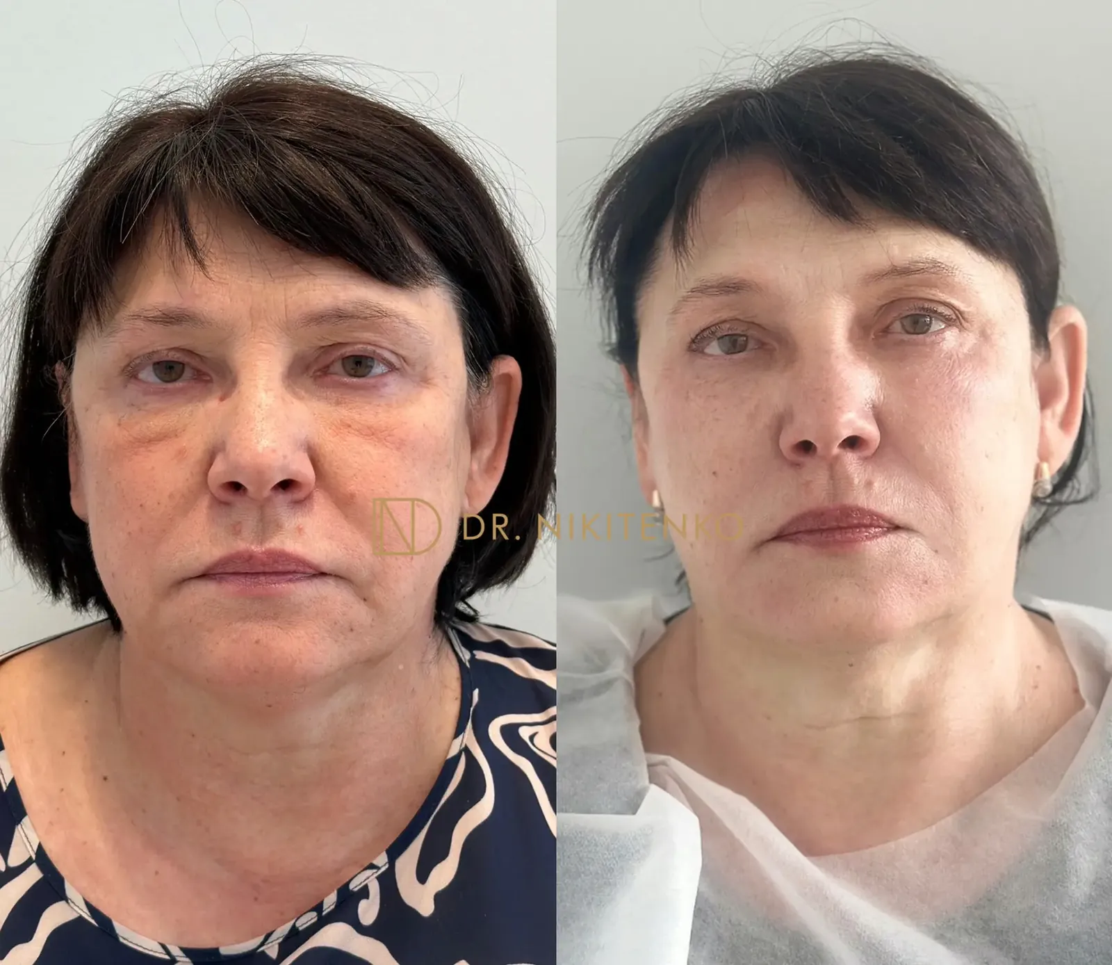 Нехирургический лазерный лифтинг ENDOLIFT: фото до и после