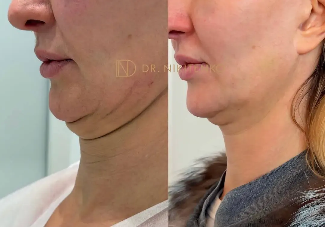 Нехирургический лазерный лифтинг ENDOLIFT: фото до и после