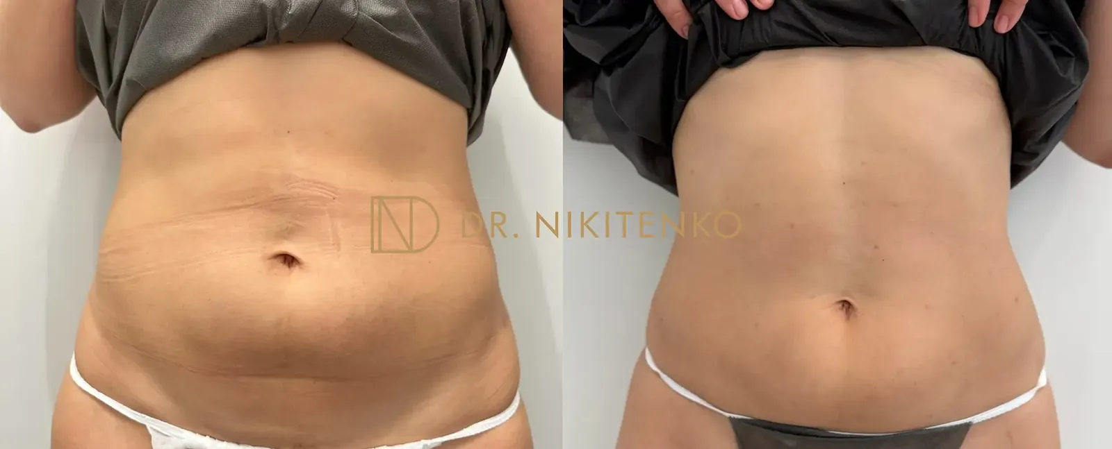 Нехирургический лазерный лифтинг ENDOLIFT: фото до и после