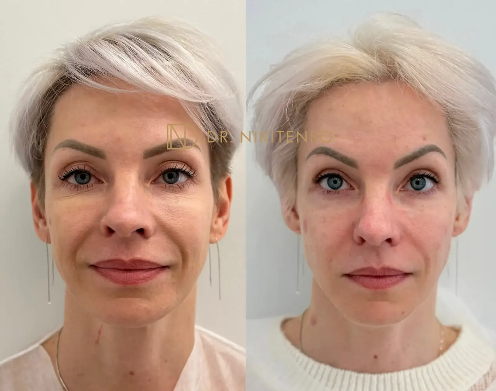 Нехирургический лазерный лифтинг ENDOLIFT: фото до и после